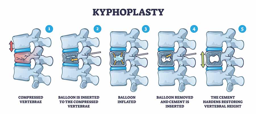 Kyphoplasty Treatment Specialist in Greenacres FL and Port St. Lucie FL.