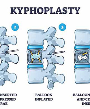 Kyphoplasty Treatment Specialist in Greenacres FL and Port St. Lucie FL