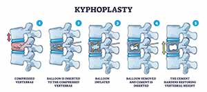 Kyphoplasty Treatment Specialist in Greenacres FL and Port St. Lucie FL.
