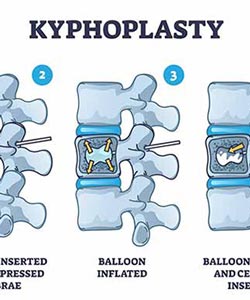 Kyphoplasty Treatment Specialist in Greenacres FL and Port St. Lucie FL