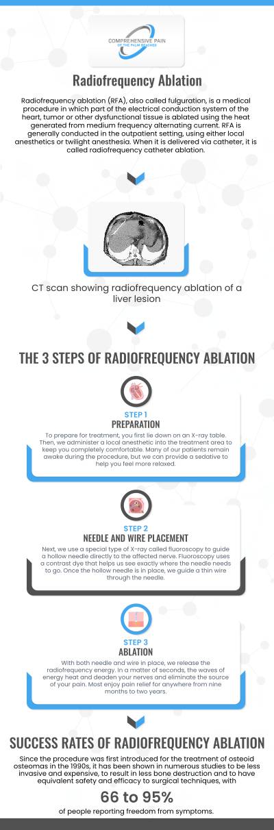 Radiofequency Ablation Treatment Specialist in Greenacres FL and Port St. Lucie FL.