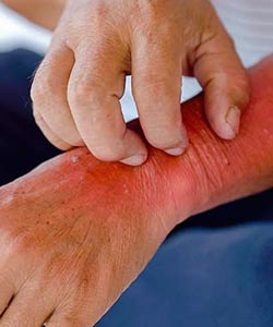 Shingles Pain Treatment Specialist in Greenacres FL and Port St. Lucie FL. Shingles Pain Treatment Specialist in Greenacres FL and Port St. Lucie FL.